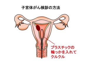 子宮体癌検査